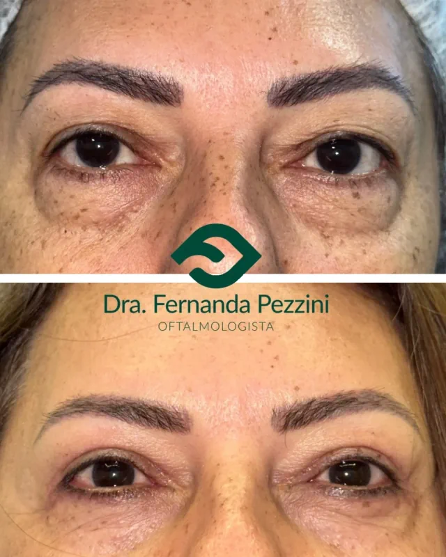 Blefaroplastia: comparação de antes e depois