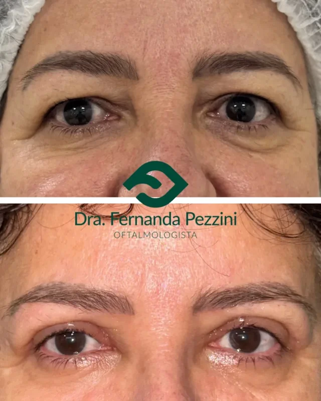 Blefaroplastia: comparação de antes e depois