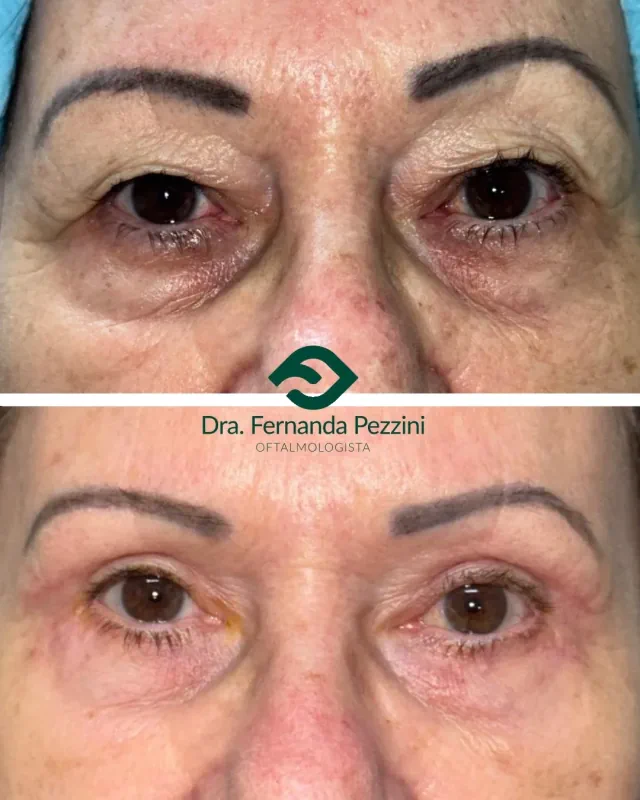Blefaroplastia: comparação de antes e depois
