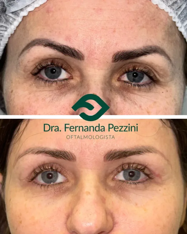 Lifting de sobrancelhas: comparação de antes e depois
