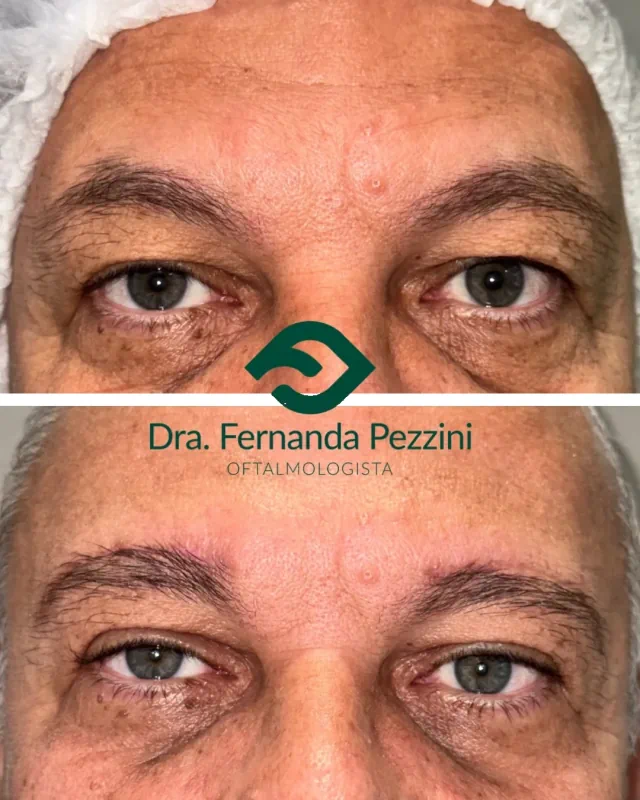 Lifting de sobrancelhas: comparação de antes e depois