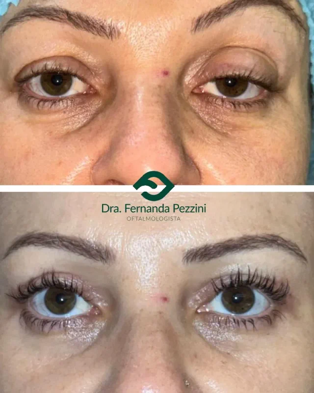 Ptose palpebral: comparação de antes e depois