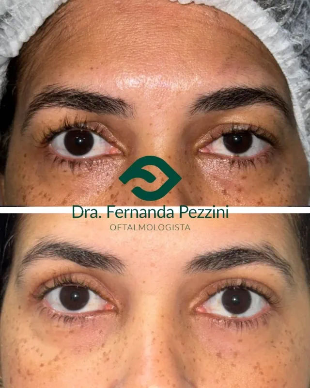 Ptose palpebral: comparação de antes e depois